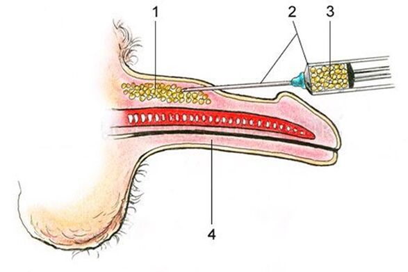 Lipofilling - inserting fatty tissue into the shaft of the penis