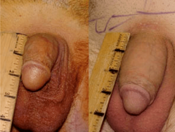 Before and after fat grafting and gel grafting