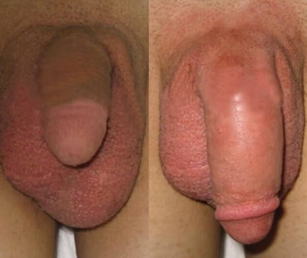 The result of inserting the collagen matrix into the penis
