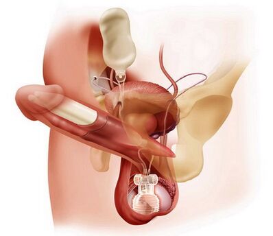 Penis enlargement surgery