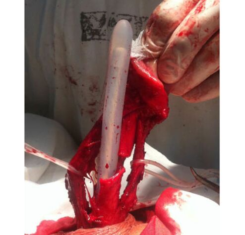 Muscle tissue implantation to enlarge the penis
